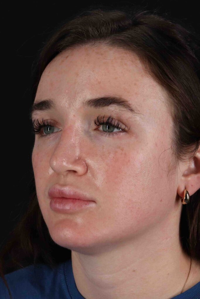 After - left_oblique