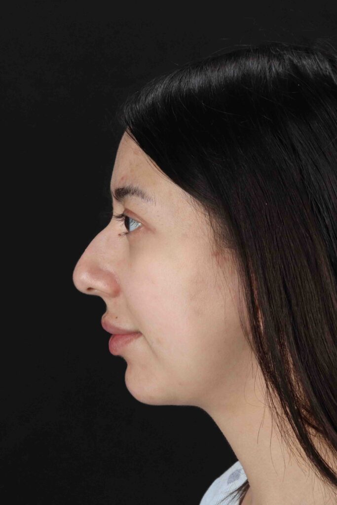 Before - left_lateral