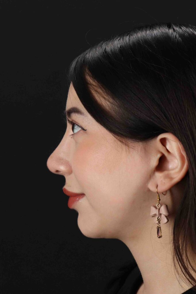 After - left_lateral