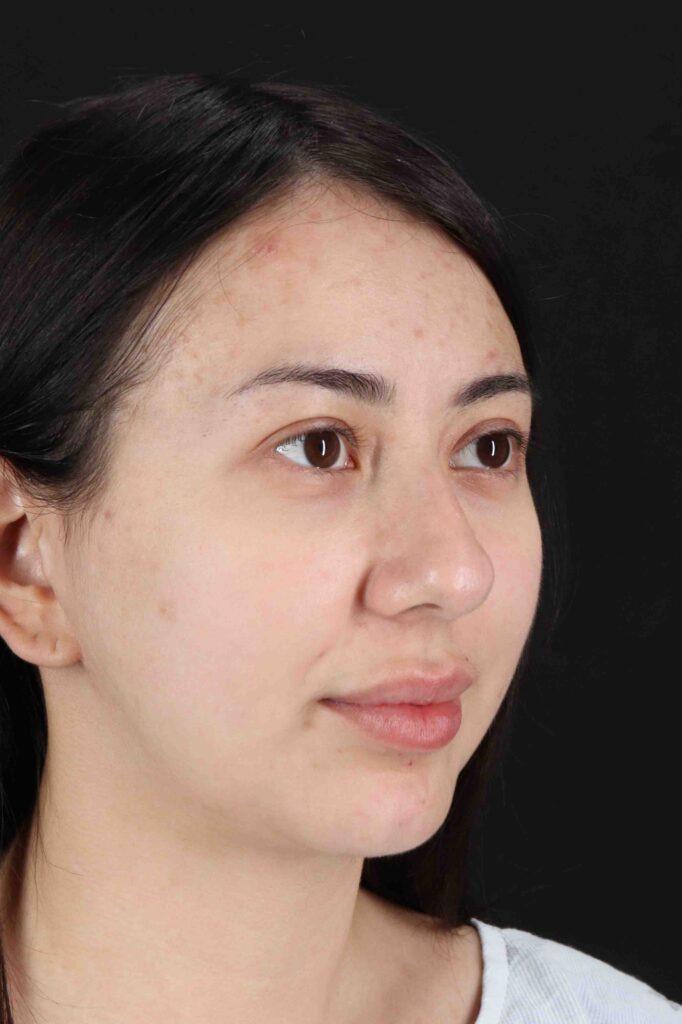 Before - right_oblique