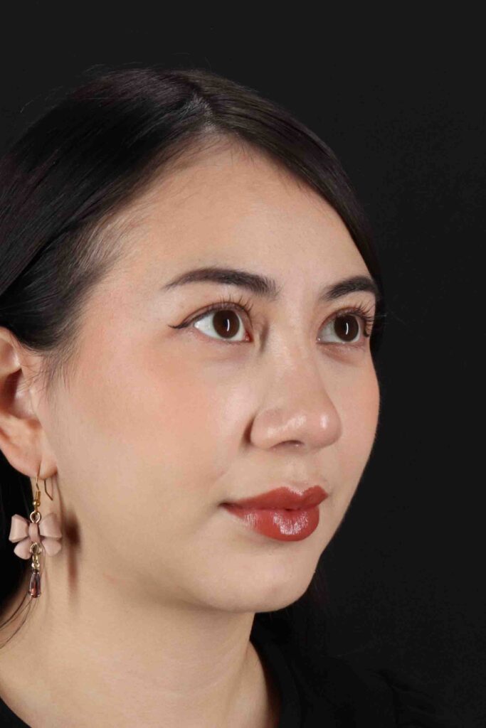 After - right_oblique