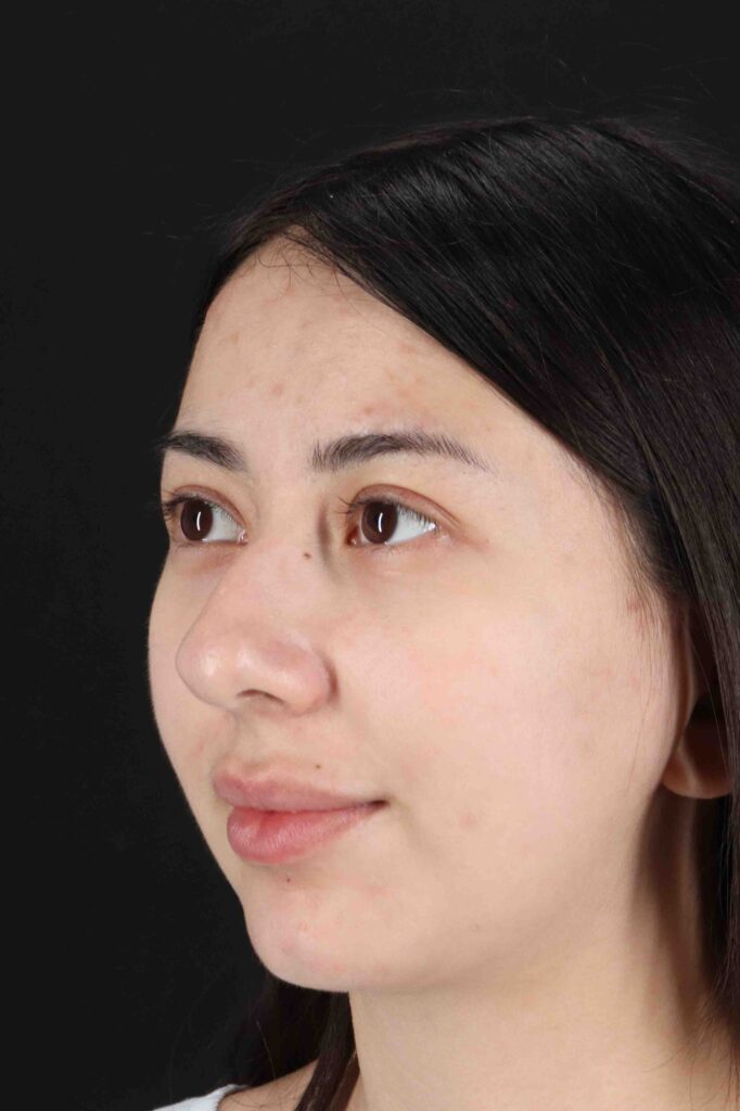 Before - left_oblique