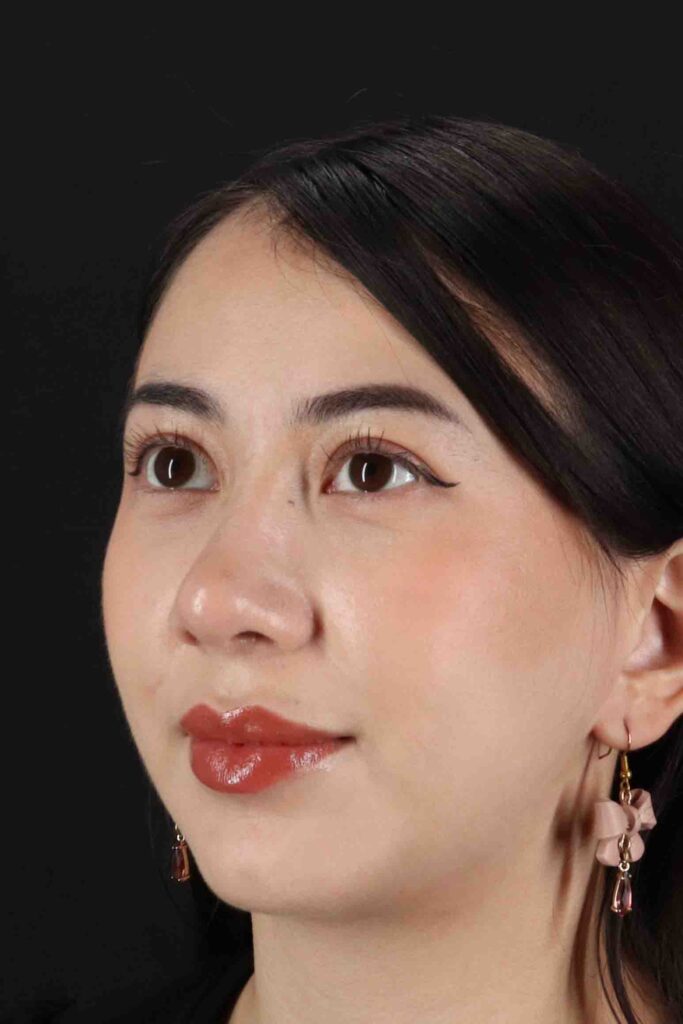 After - left_oblique