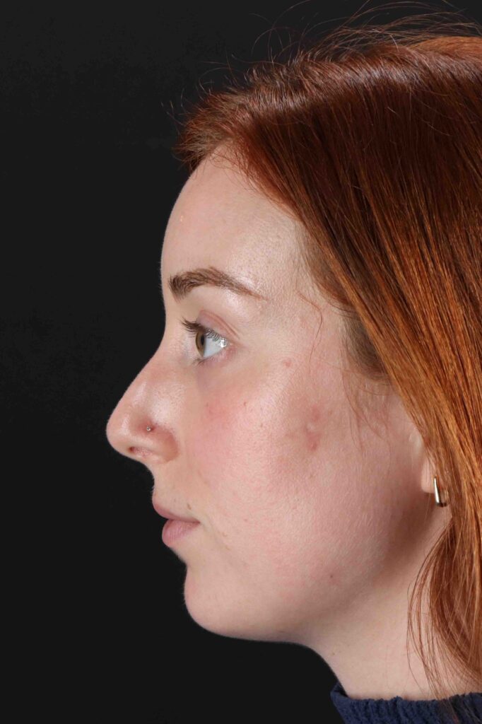 Before - left_lateral