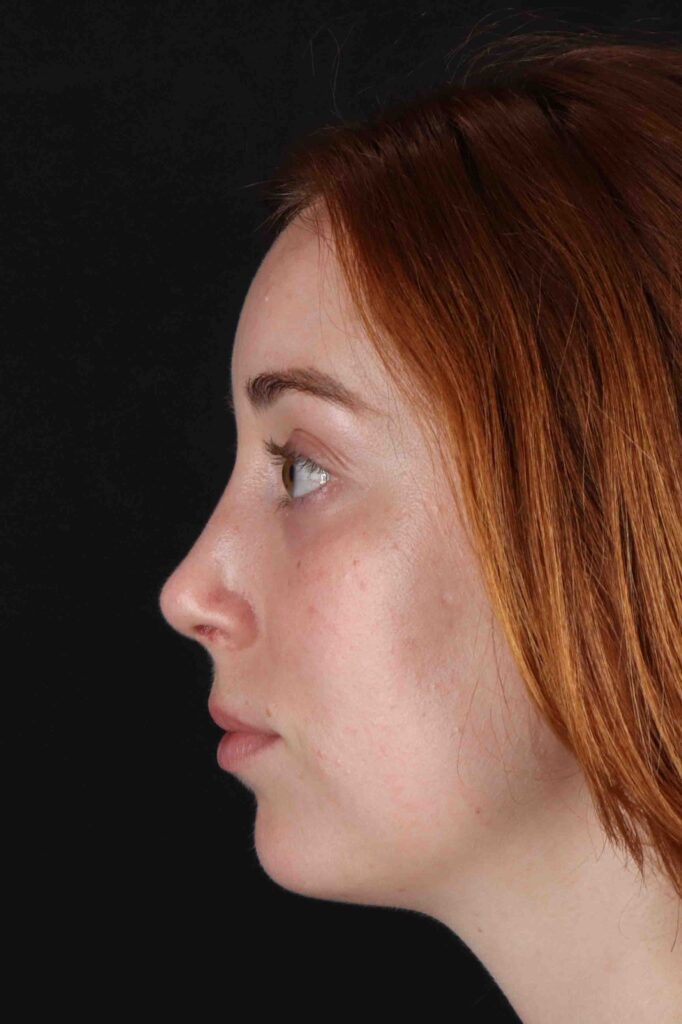 After - left_lateral