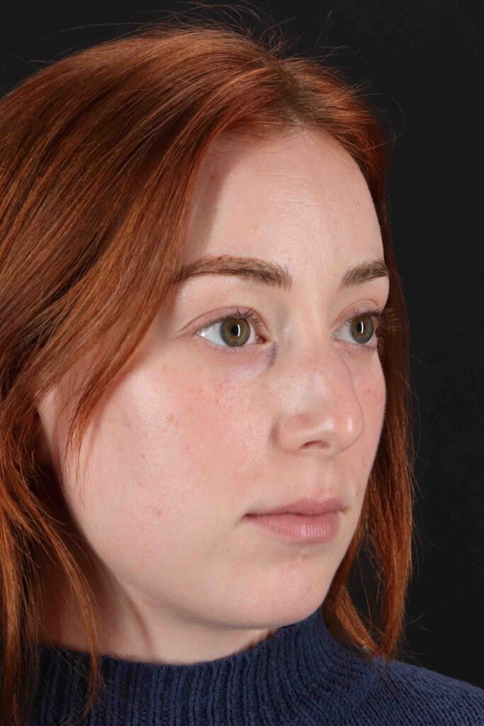 Before - right_oblique