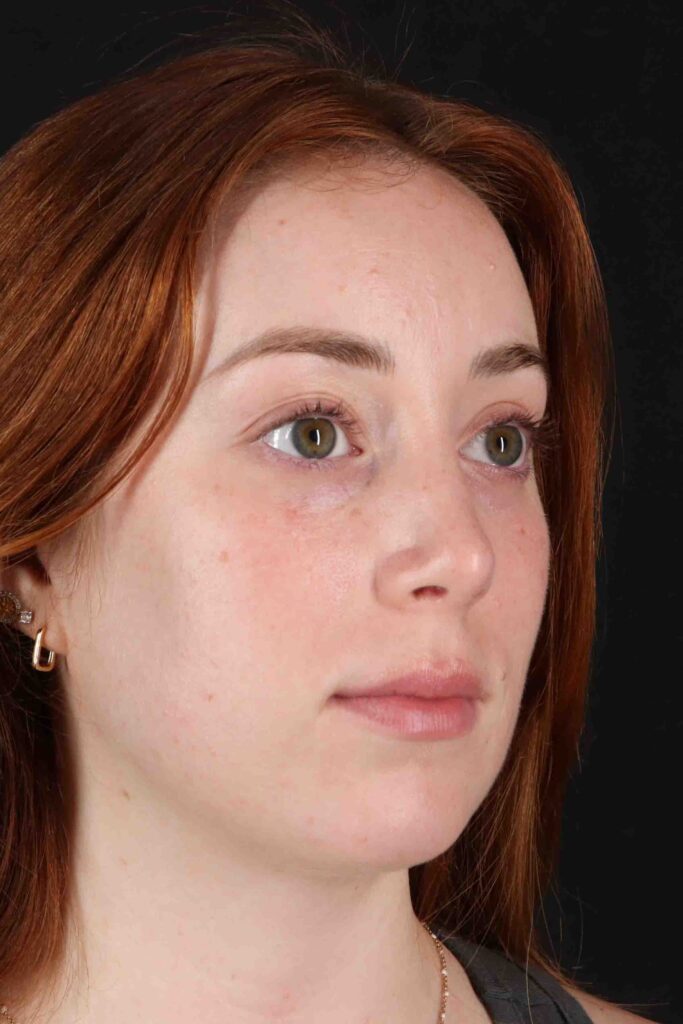 After - right_oblique