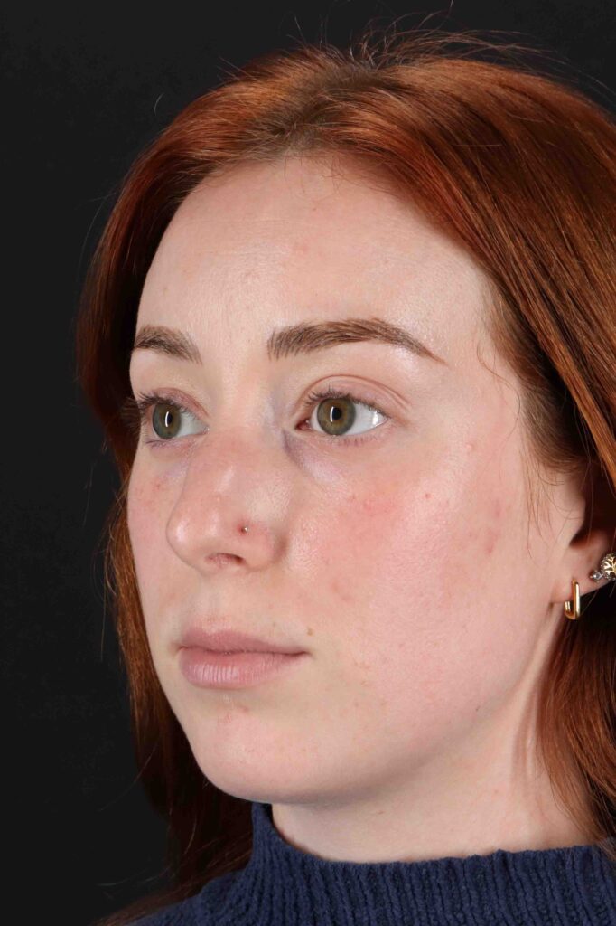 Before - left_oblique