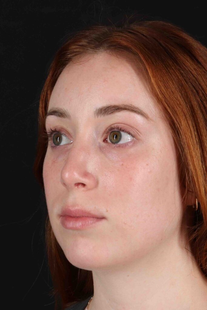 After - left_oblique