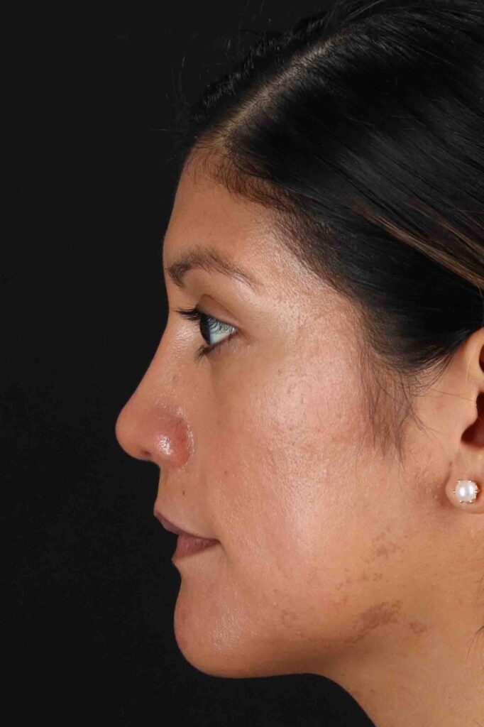 After - left_lateral