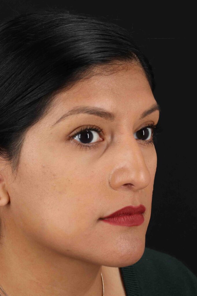 Before - right_oblique