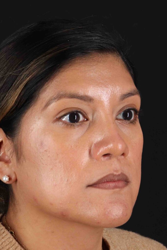 After - right_oblique