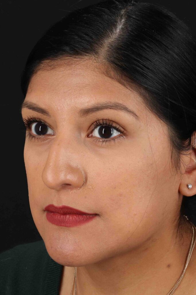 Before - left_oblique