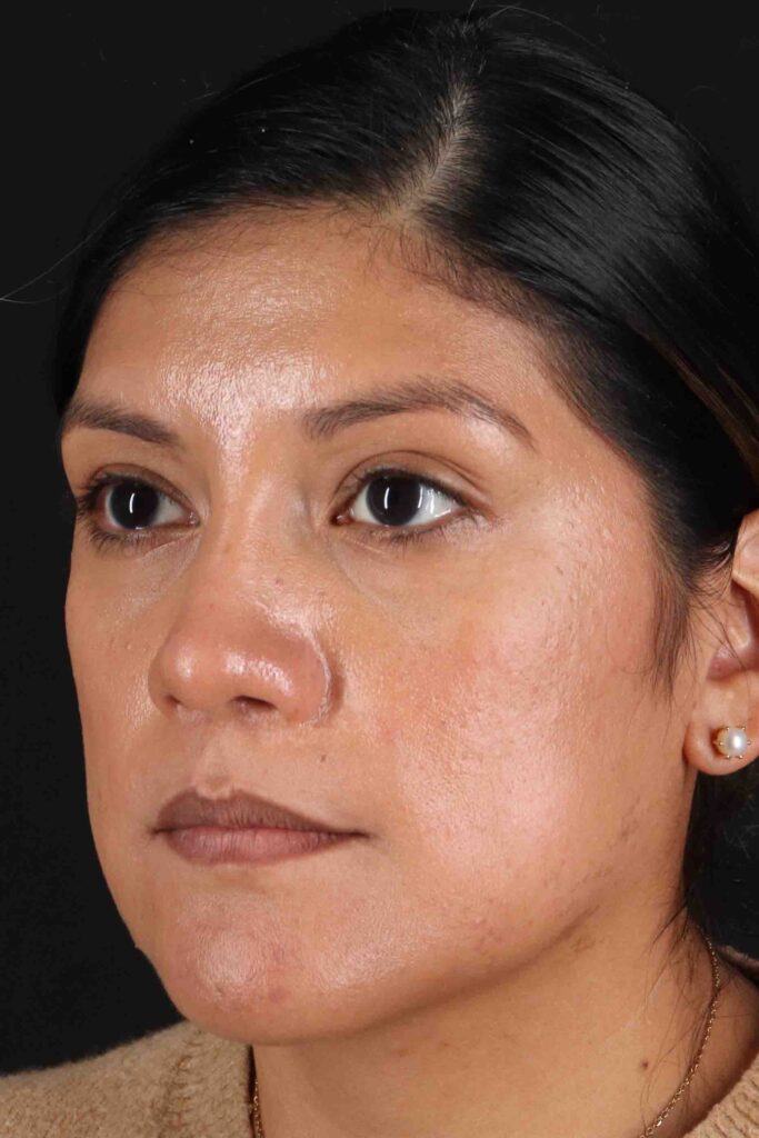 After - left_oblique