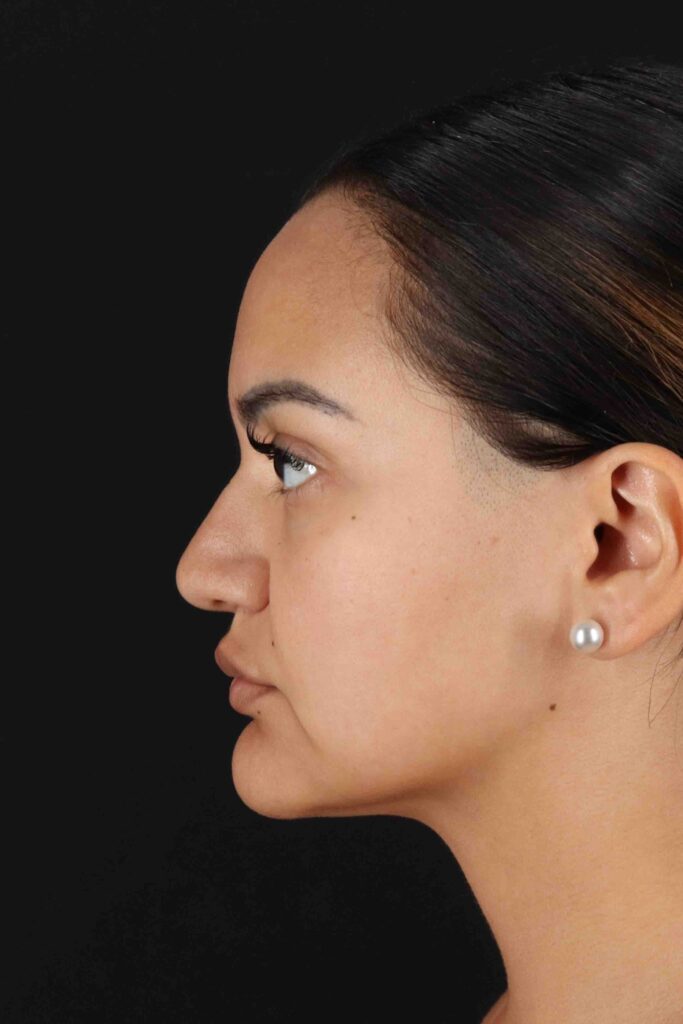 Before - left_lateral