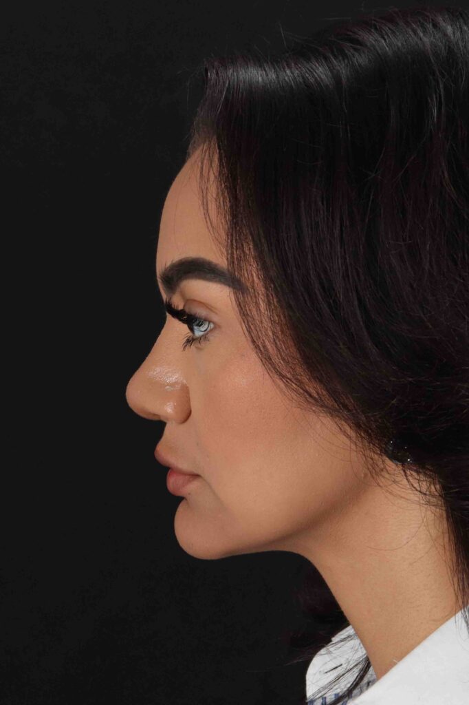 After - left_lateral