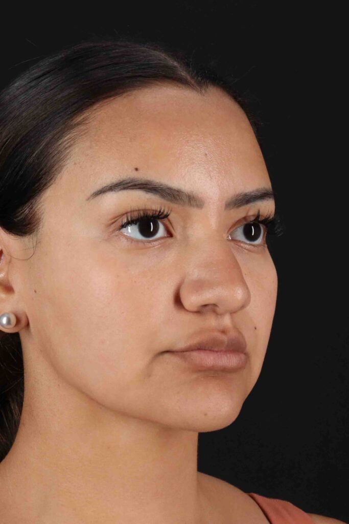 Before - right_oblique