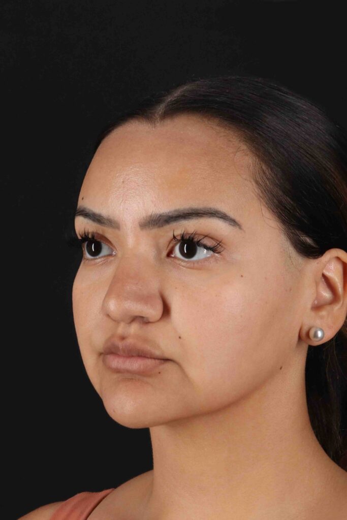 Before - left_oblique