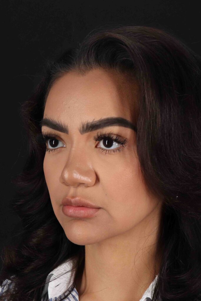 After - left_oblique