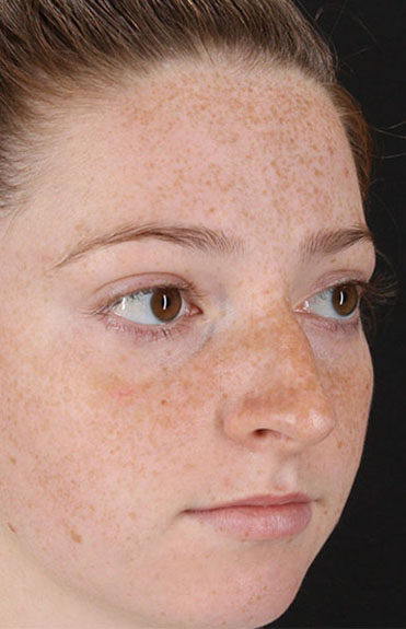 Before - right_oblique