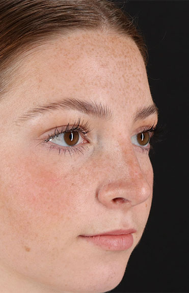 After - right_oblique