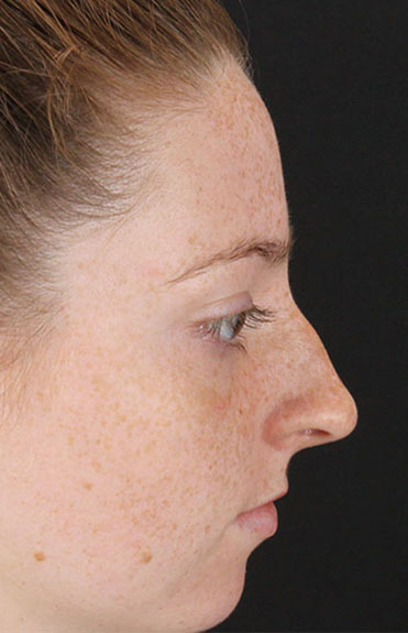 Before - right_lateral