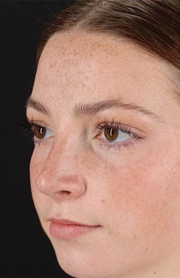 After - left_oblique