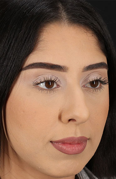 Before - right_oblique