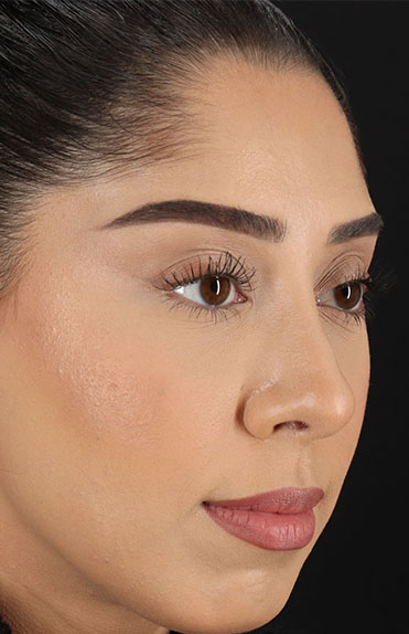 After - right_oblique