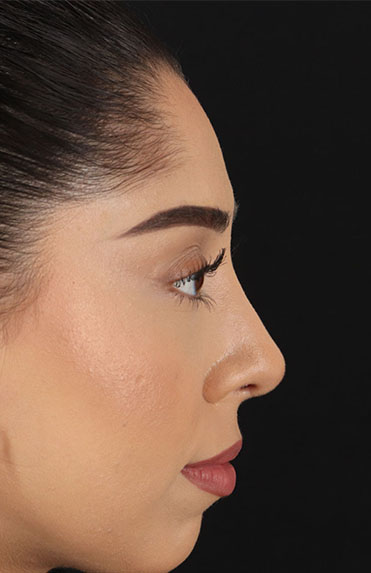 After - right_lateral