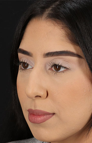 Before - left_oblique