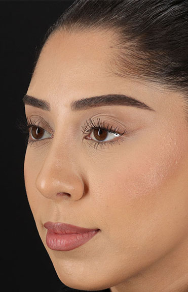 After - left_oblique