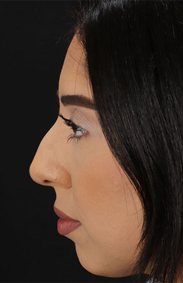 Before - left_lateral