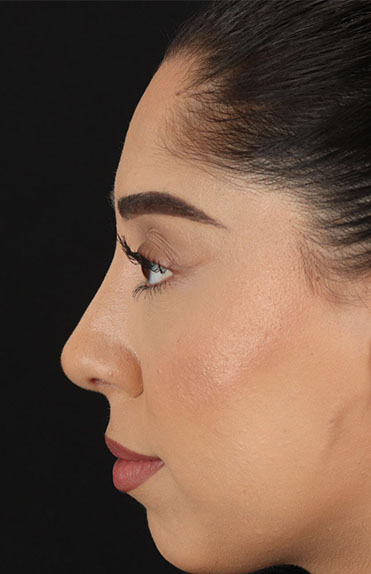 After - left_lateral