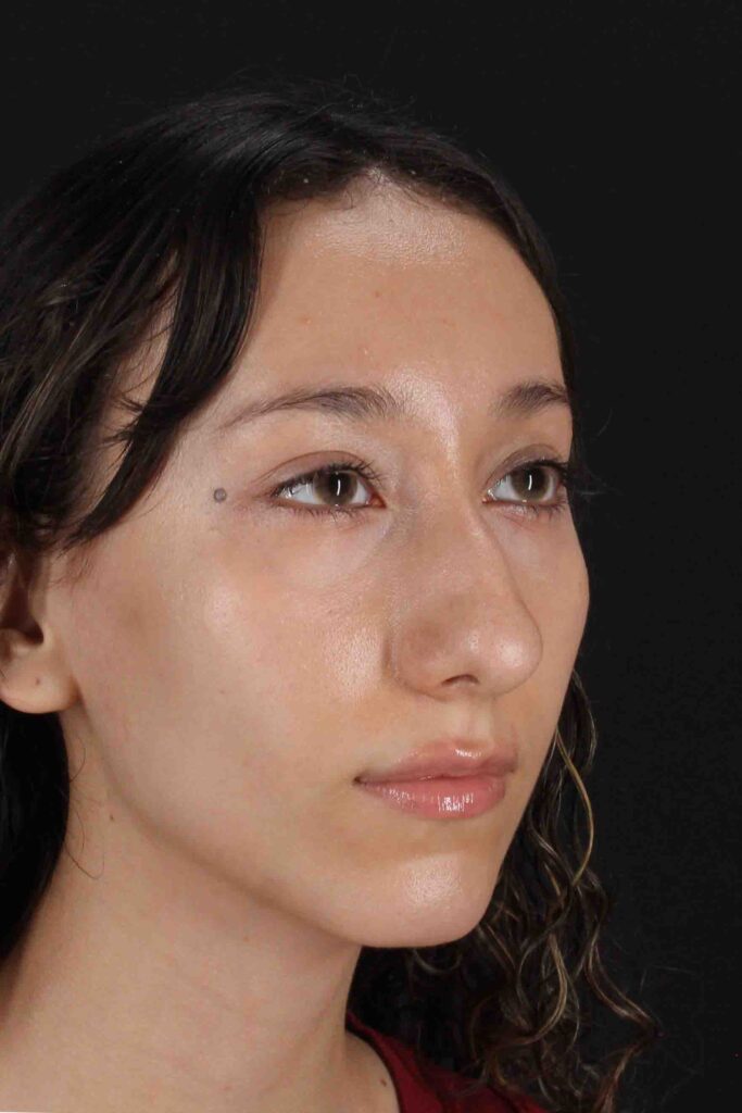 Before - right_oblique