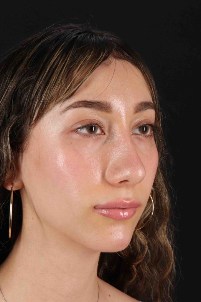 After - right_oblique