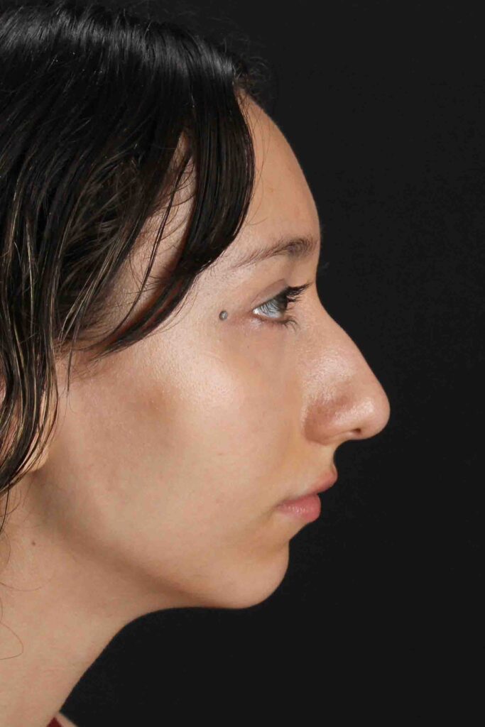 Before - right_lateral