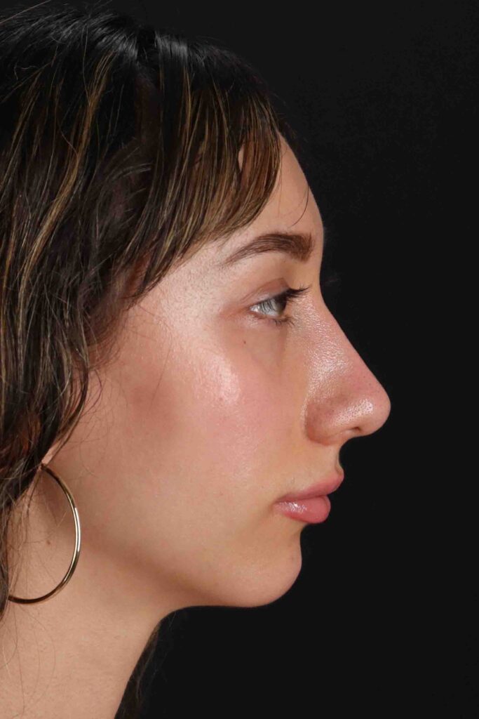 After - right_lateral