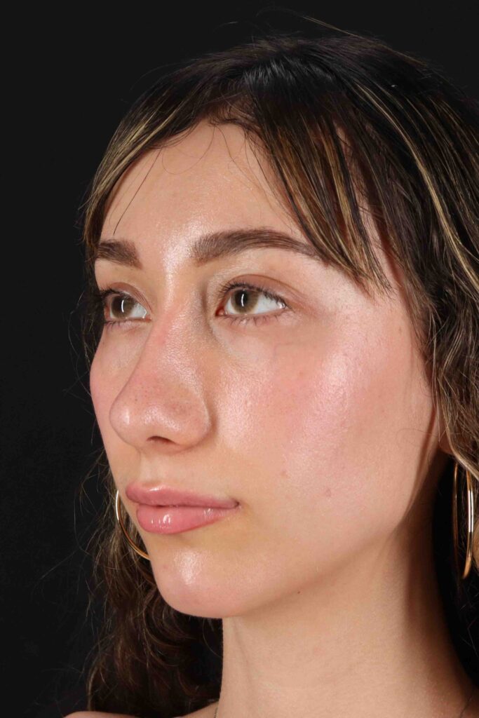 After - left_oblique