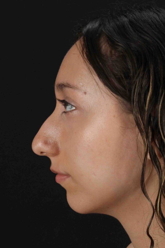 Before - left_lateral