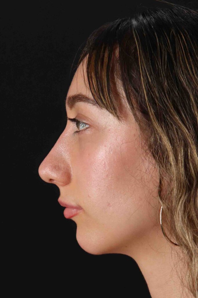 After - left_lateral