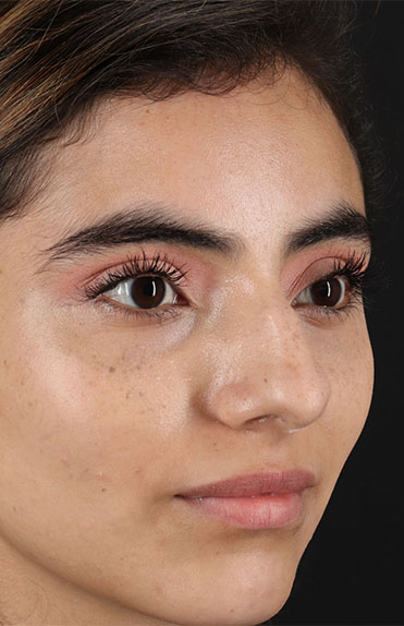 Before - right_oblique