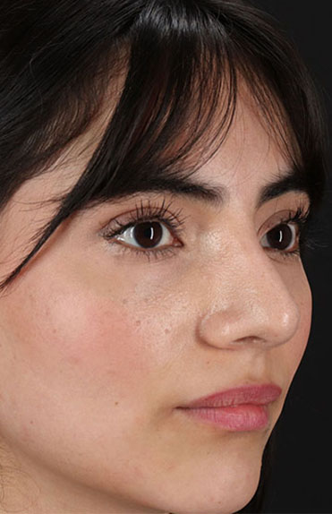 After - right_oblique