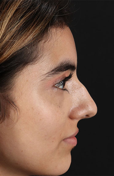 Before - right_lateral