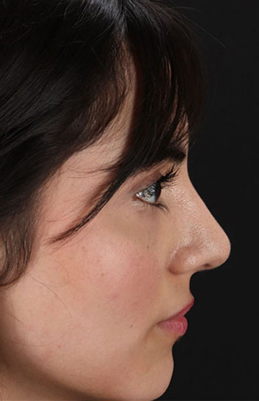 After - right_lateral