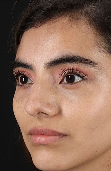 Before - left_oblique