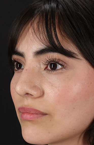 After - left_oblique