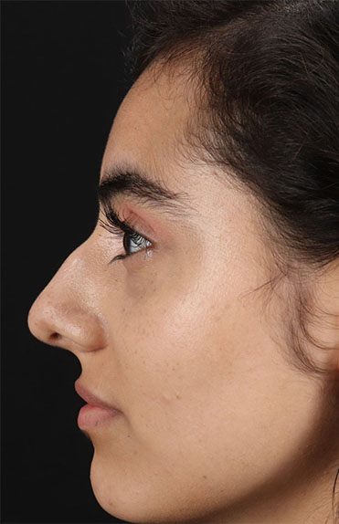 Before - left_lateral