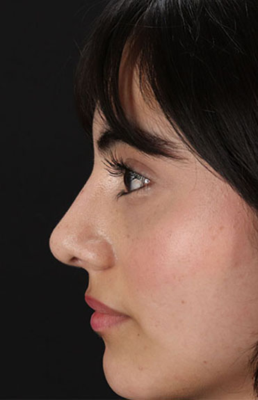 After - left_lateral