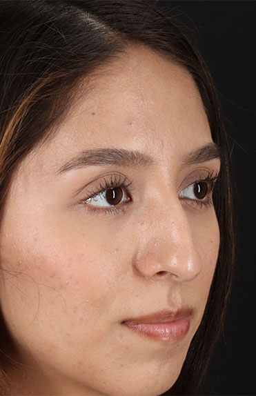 Before - right_oblique